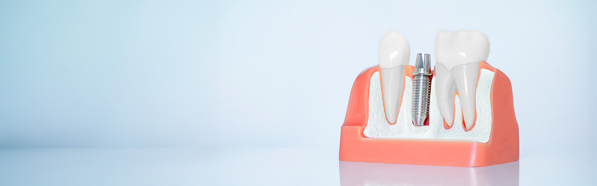 当院のインプラント治療